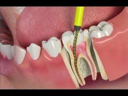 Root Canals